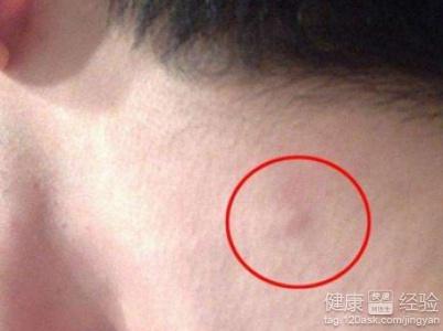 腹部溝酸脹是淋巴發(fā)炎嗎_腹股溝淋巴結(jié)觸診_腹股斜溝疝要不要緊